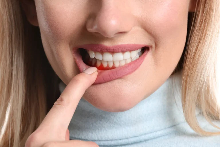 Periodontal Maintenance